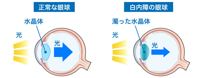 白内障症状